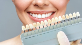 BLANCHIMENT DENTAIRE