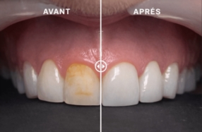 FACETTES DENTAIRES
